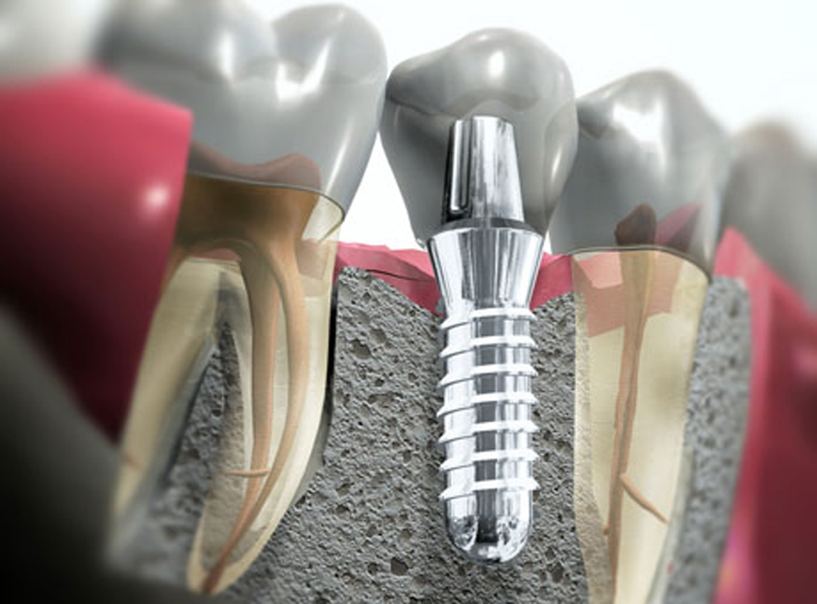 Implantologia Osteointegrata Implantologia Osteointegrata