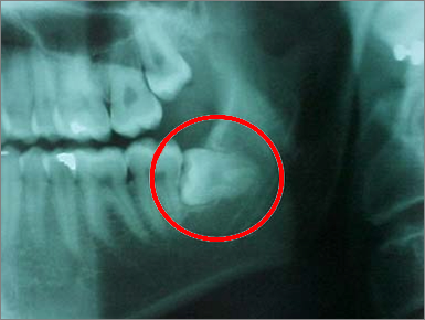 dente in inclusione ossea