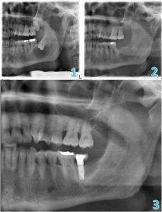 Curetta Parodontale - SDM26 - Hu-Friedy - Per Detartraggio Dentale / Doppia