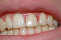 ricostruzione dente