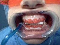 tecnica di sbiancamento dentale