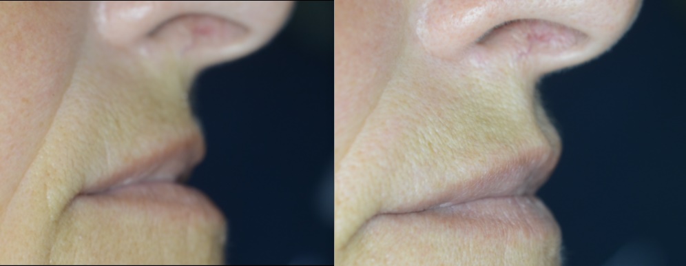  Filler Oro Facciali Estetica Ed Odontoiatria Centro Odontoiatrico Roma