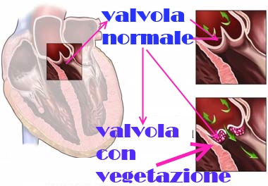 valvulopatia endocardica