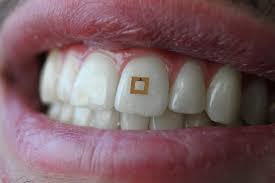 sensore sul dente
