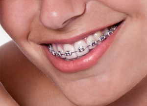 apparecchio ortodontico fisso
