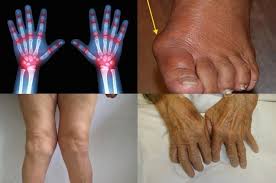 siti di artrite reumatoide