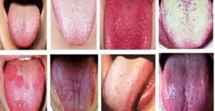 condizioni patologiche svelate dalla lingua